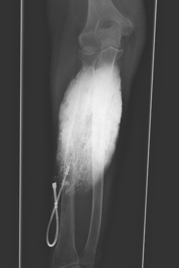 BIDMC Musculoskeletal Imaging & Intervention (@bidmc_mskimg) on Twitter photo It's time for <a href="/BIDMC_MSKImg/">BIDMC Musculoskeletal Imaging & Intervention</a>'s interesting case of the week!
ā¬ļø ā¬ļø ā¬ļø
Case # 122:
History withheld.
Diagnosis?
Reply by Friday, March 31!
#MSKRad #MedTwitter #RadRes #RadFellows It's time for <a href="/BIDMC_MSKImg/">BIDMC Musculoskeletal Imaging & Intervention</a>'s interesting case of the week!
ā¬ļø ā¬ļø ā¬ļø
Case # 122:
History withheld.
Diagnosis?
Reply by Friday, March 31!
#MSKRad #MedTwitter #RadRes #RadFellows