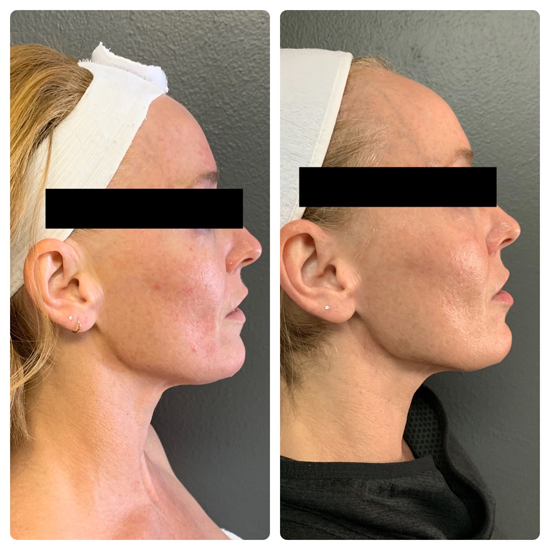 LLMSGtown's tweet photo. Things You Need To Know About Microneedling And RF
https://t.co/2GepwaLRCB 
#microneedling #esthetician #skintightening https://t.co/m8jFrA8Hhg