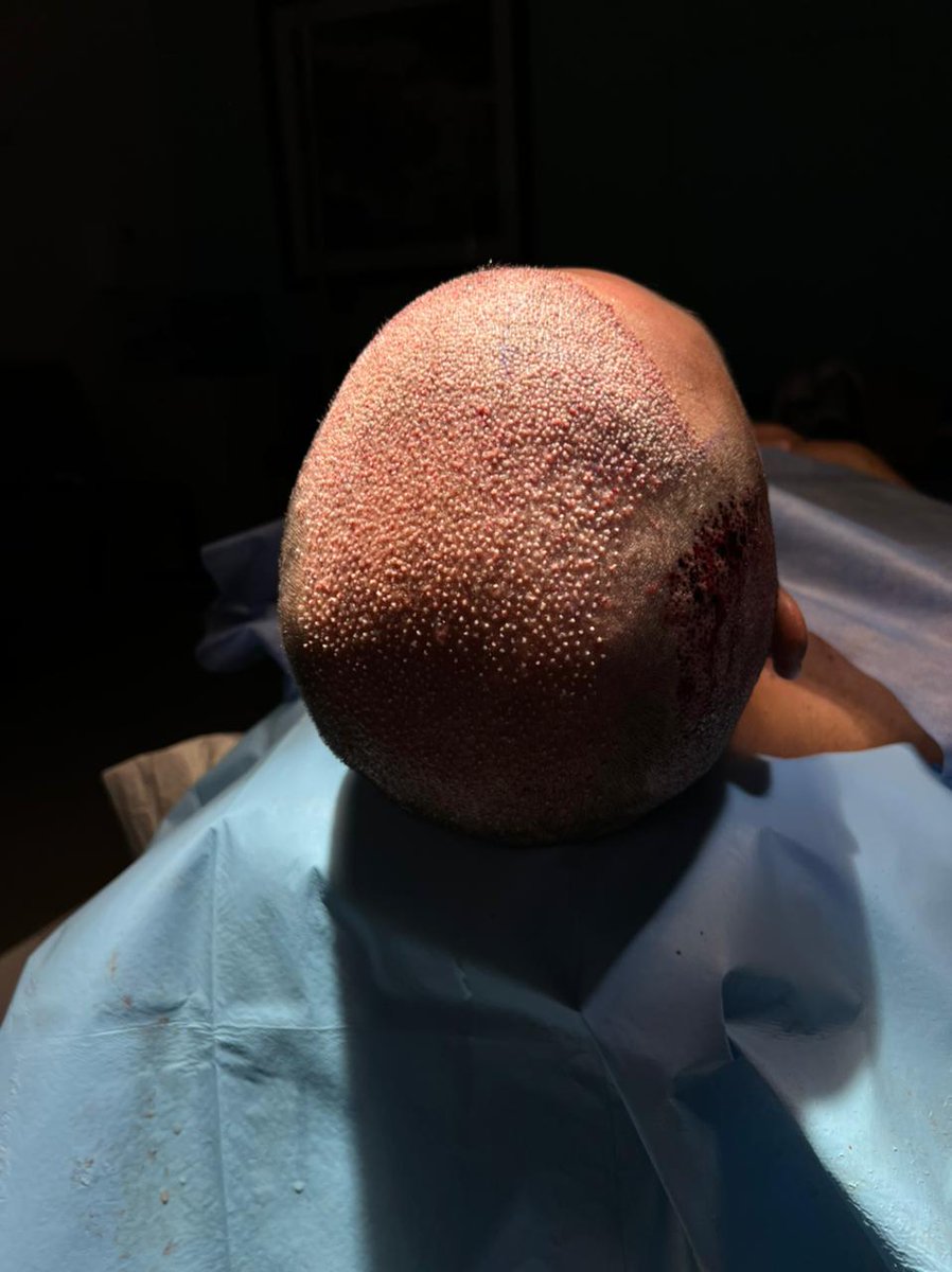 In the end of the DHI method of hair transplant
#hairtransplantation #hairtransplantationincancun #hairinmexico #clinicincancun #beardtransplantation #browstransplantation #dhihairtransplantation #dhihairtransplantcancun #implantecapilar #dhimethod #hairimplantation #hair