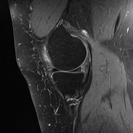 mskteachingroom's tweet photo. Typical meniscal ramp lesion 💡

Third slide showing illustration adapted from this excellent article https://t.co/7tBIDWlu4s 
@atultanejamd 

#radfellow #radiologyfellow #radiologyresident #learningradiology #radres #mskrad #radtwitter #radiology #transformingradiology #MRI https://t.co/Ss070hnQgp