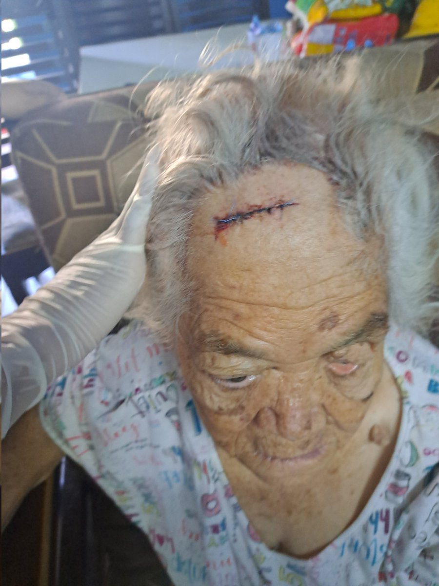 Rastaman0688's tweet photo. Y asi de grande es la herida de mi abuela, gracias a Dios no paso a más, gracias a Todos los que han estado pendiente con el caso de mi viejita, ya ella esta mejor! #elalbo #perroalbo https://t.co/vR72ncbg1F