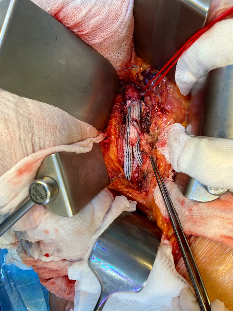 The old style way for Rutherford II 4 #veterosurgery #aorta