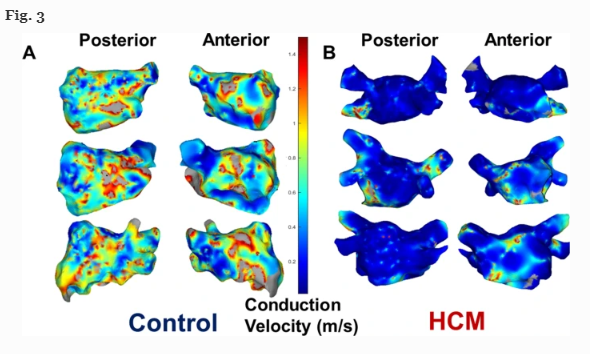 JICE_EP's tweet photo. 🚨New #FreeRead Article in 
@JICE_EP

Conduction Velocity is Reduced in the Posterior Wall of HCM Pts with Normal Bipolar Voltage Undergoing Ablation for PAF

by S Zahid @DrCardioCon @DavidParkLab1 @CRB_EP @azrielleib @ExtraStim &amp; Colleagues

📖🧐 https://t.co/E6y81684HL

#EPeeps https://t.co/7RMM4BfyJb