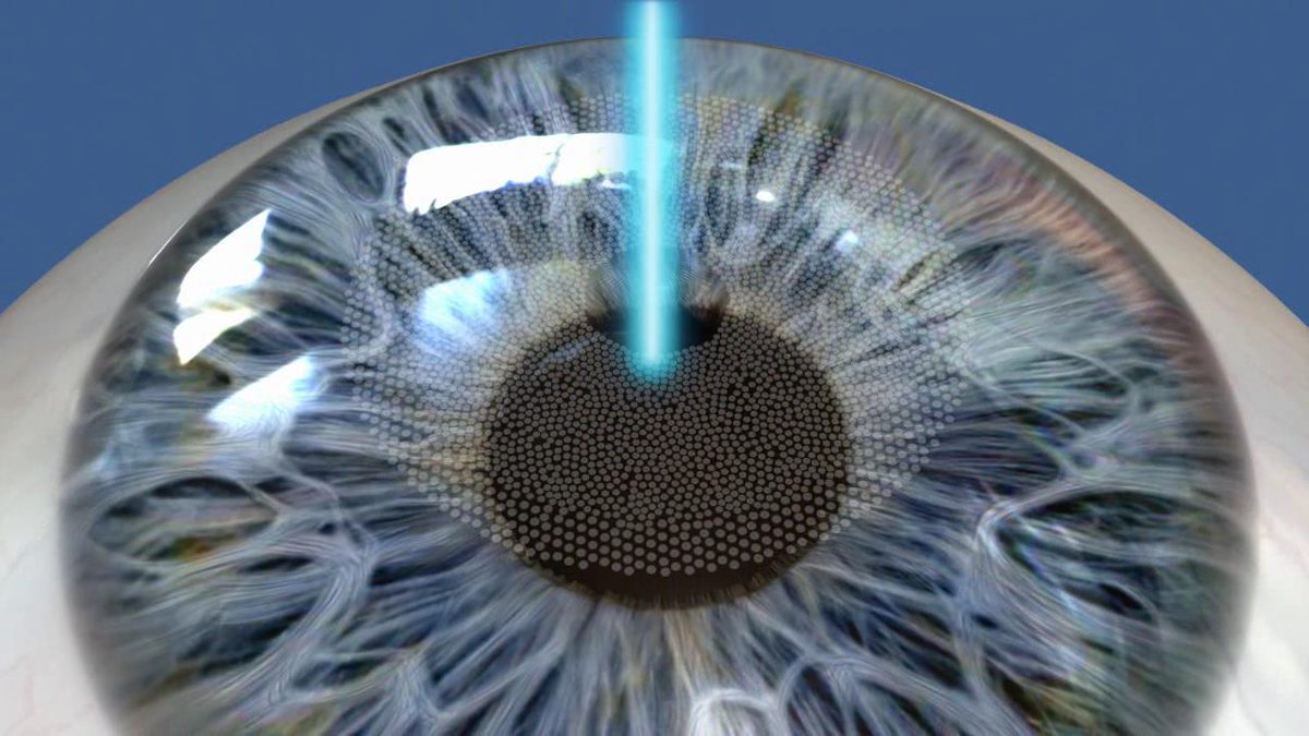 ow.ly/vG11104z8iA ow.ly/VGHH104A2KL Trends in corneal treatment include cutting-edge advancements - Ophthalmology Times