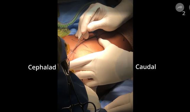 AAOS1's tweet photo. This week's #OrthoBlink answer is: Open #Resection of #Heterotopic #Ossification of the #Glenohumeral and #Coracoclavicular Space. 

Watch the full video on OVT:
https://t.co/dhR2cfBr5x

#OVTFridays
#complications
#contracture
#shoulder
#elbow
#pathology
#pathologic bone https://t.co/hnFqOAQyPT