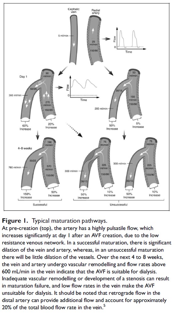 #Nephtwitter Fístulas Arterio-Venosa como acceso vascular ☝🏼 Acceso ideal para inicio HD, por ello importante su 'maduracion' ⬇️ Proceso mediante el cual se busca una dilatación venosa capaz de presentar flujos >600ml/min ✍🏼 👀Vías típicas de MADURACIÓN 👇🏼 #MedTwitter #MedEd