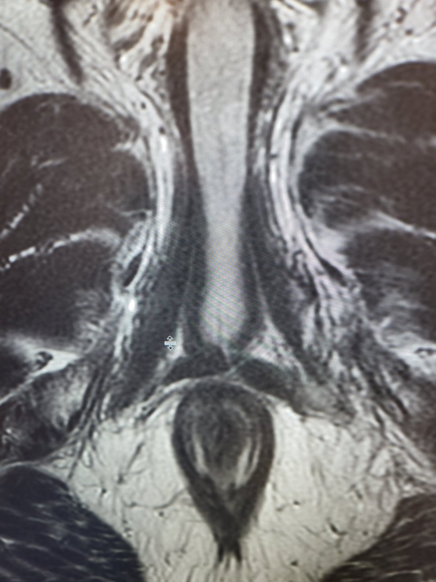 Have you ever seen transverse perineal muscles this thick? 
Ques : Wht are the functions of transverse perineal muscles? Answer in comments.
<a href="/SAR_ProstateDFP/">SAR Prostate DFP</a> <a href="/YaleRadRes/">Yale Radiology Residents</a>