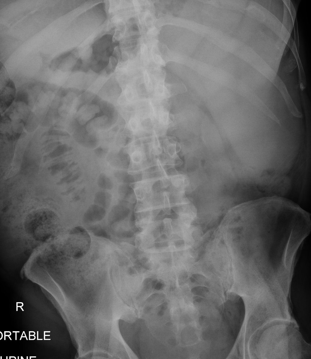 xsectional's tweet photo. You don't always need cross-sectional imaging to call it splenomegaly. 

#MedTwitter https://t.co/l8FuHTLMNQ
