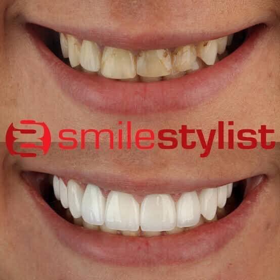 haidy_hegazy's tweet image. مساء الخير 
انا بعمل ماجيستر تركيبات ثابتة فى كلية طب اسنان جامعة عين شمس 
محتاجة حالات عايزة تعمل فينيرز veneers 
لو فى فراغات بين الاسنان ، اصفرار او تصبغات زى الصور
بدون تكلفة