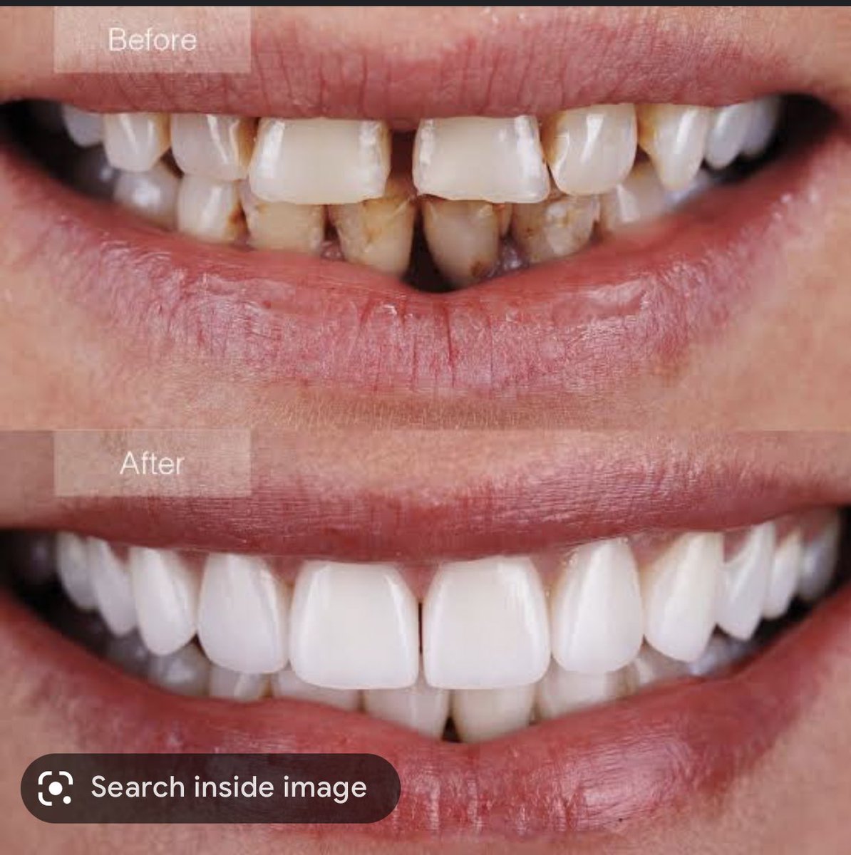 haidy_hegazy's tweet image. مساء الخير 
انا بعمل ماجيستر تركيبات ثابتة فى كلية طب اسنان جامعة عين شمس 
محتاجة حالات عايزة تعمل فينيرز veneers 
لو فى فراغات بين الاسنان ، اصفرار او تصبغات زى الصور
بدون تكلفة