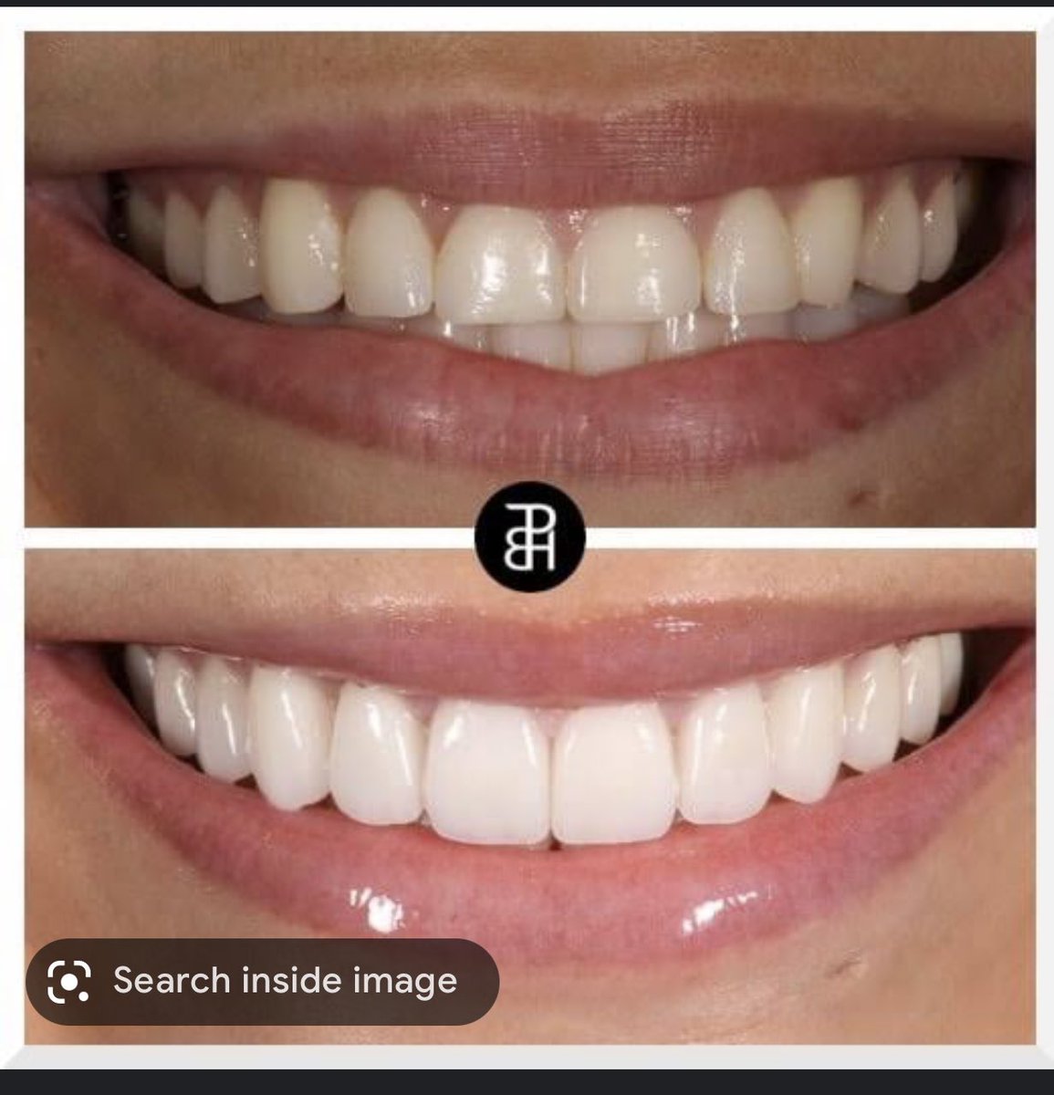 haidy_hegazy's tweet image. مساء الخير 
انا بعمل ماجيستر تركيبات ثابتة فى كلية طب اسنان جامعة عين شمس 
محتاجة حالات عايزة تعمل فينيرز veneers 
لو فى فراغات بين الاسنان ، اصفرار او تصبغات زى الصور
بدون تكلفة