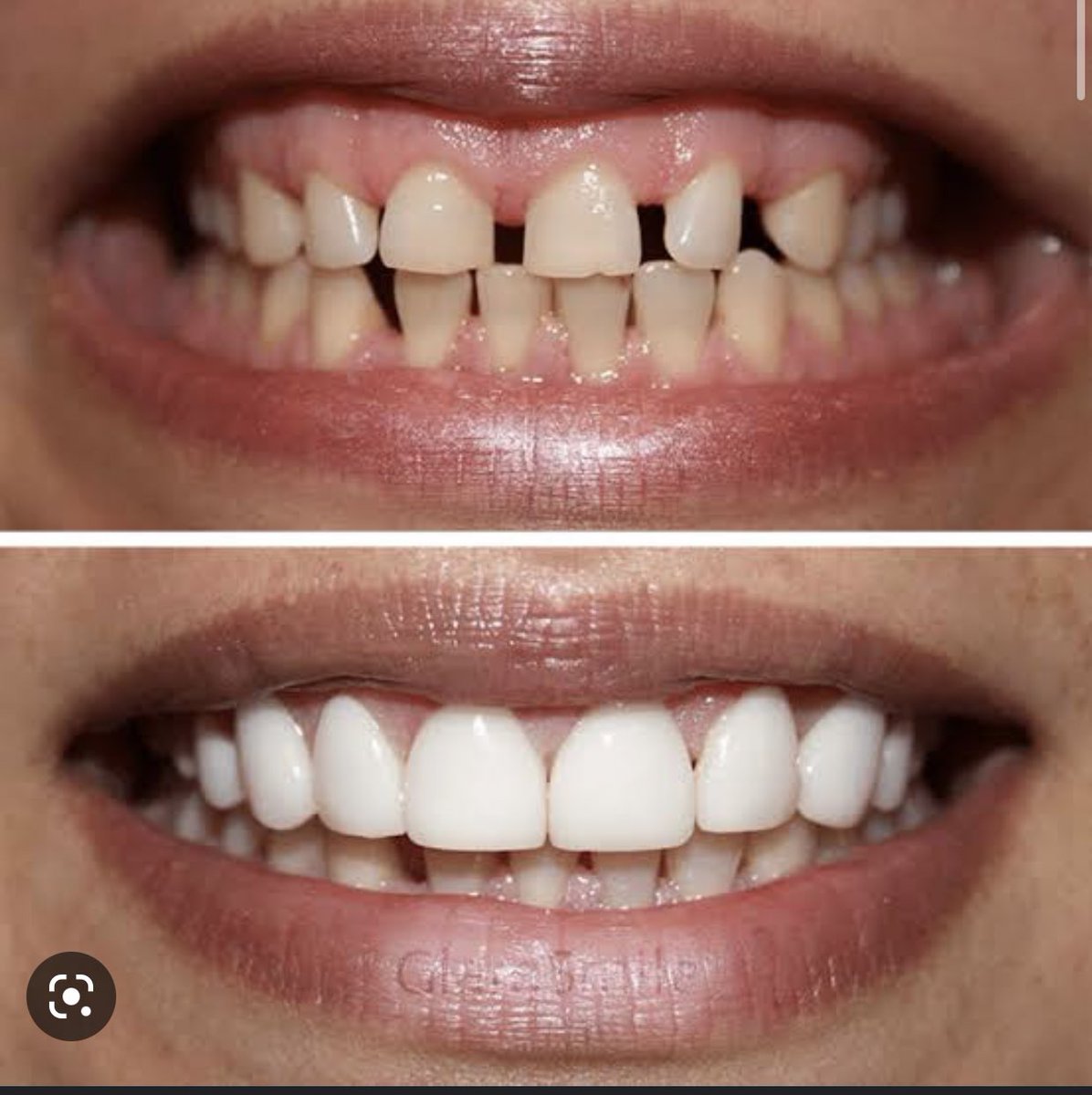 haidy_hegazy's tweet image. مساء الخير 
انا بعمل ماجيستر تركيبات ثابتة فى كلية طب اسنان جامعة عين شمس 
محتاجة حالات عايزة تعمل فينيرز veneers 
لو فى فراغات بين الاسنان ، اصفرار او تصبغات زى الصور
بدون تكلفة