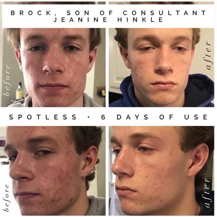 wnick's tweet photo. Time to get ready for Prom Season! Great skin is your best accessory!  Start now and in 60 days your skin will be prom ready!  Spotless has a 60 day money back guarantee!  It really works on teen face and back acne! #WandaNickleburRF  #confidence https://t.co/YCjOqvEZtI https://t.co/2A0oFyY194