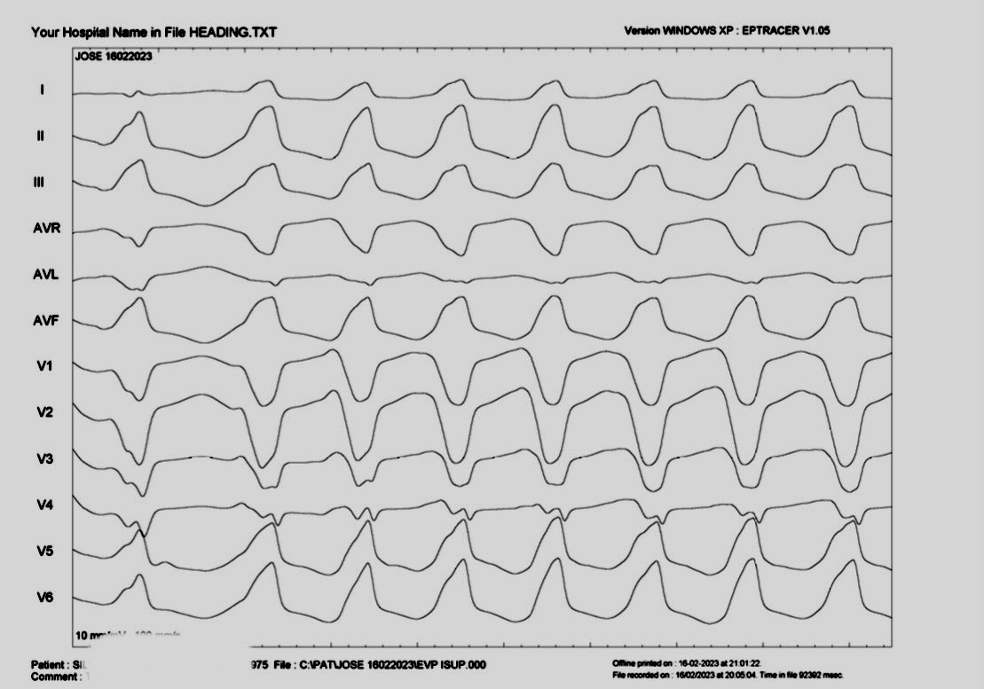 educostacardiol's tweet photo. Electrical storm on ARVC: #23 S-ICD shocks on VT . Successful RVOT RF ablation ⚡️ 💓#EPeeps #hospitalvivalle #S-ICD  #Carto3 #Arrhythmia #ventriculartachycardia #catheterablation https://t.co/OvIi9LI7hu