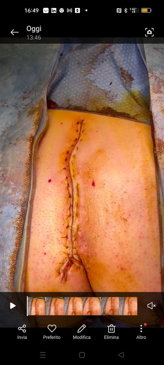 Francesco Cantarella MD, PhD, FACS (@cantarelladr) on Twitter photo Huge PS relapse...no space for MIS
Bascom's cleft lift
<a href="/SoMe4Proctology/">SoMe4Proctology</a> <a href="/escp_tweets/">European Society of Coloproctology</a> <a href="/DrUgoGrossi/">Ugo Grossi</a> <a href="/luciacolorectal/">Lucia Oliveira,MD,PhD</a> <a href="/ZimNl/">David Zimmerman</a> <a href="/SPerdawood/">Sharaf Perdawood</a> <a href="/nlavellaneda/">Nicolas Avellaneda</a> <a href="/nikk79it/">Nicola Antonacci</a> <a href="/GianlucaPellino/">Gianluca Pellino</a> <a href="/VVigorita/">Vincenzo Vigorita MD, PhD, EBSQ-c, FACS</a> Huge PS relapse...no space for MIS
Bascom's cleft lift
<a href="/SoMe4Proctology/">SoMe4Proctology</a> <a href="/escp_tweets/">European Society of Coloproctology</a> <a href="/DrUgoGrossi/">Ugo Grossi</a> <a href="/luciacolorectal/">Lucia Oliveira,MD,PhD</a> <a href="/ZimNl/">David Zimmerman</a> <a href="/SPerdawood/">Sharaf Perdawood</a> <a href="/nlavellaneda/">Nicolas Avellaneda</a> <a href="/nikk79it/">Nicola Antonacci</a> <a href="/GianlucaPellino/">Gianluca Pellino</a> <a href="/VVigorita/">Vincenzo Vigorita MD, PhD, EBSQ-c, FACS</a>