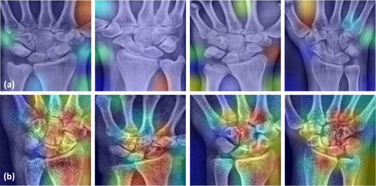 Alimedphysics's tweet photo. Our proposed #AI model detected #ScaphoidFractures with 90% accuracy! It can be a beneficial alternative to MRI for early fracture detection (especially occult) on radiographs. See more on Engineering Applications of Artificial Intelligence: https://t.co/H2ItIwElDb.
@comp_science https://t.co/MtgculIz4H