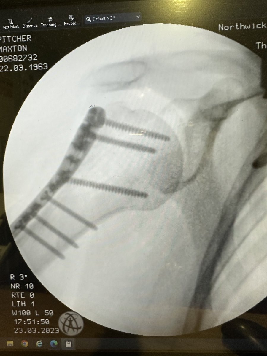 harrowgastro's tweet photo. So grateful to Messrs Sala and Akhtar for their help in rebuilding their first “bionic violinist” as my 60th birthday present and to Dr Kamali for his expert anaesthesia and pain control. The whole SAU and theatre teams ⁦@LNWH_NHS⁩ were SUPERB! Proud to still be part of it! https://t.co/PTcfvXl9Aj