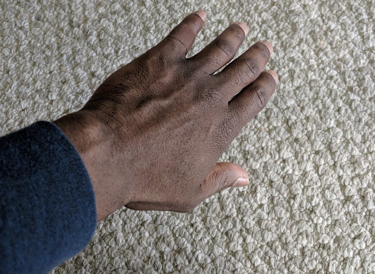 Davidjodo's tweet photo. @Izuna99 Your skin color before and after “denouncing “ your black side https://t.co/zRXxl59llv