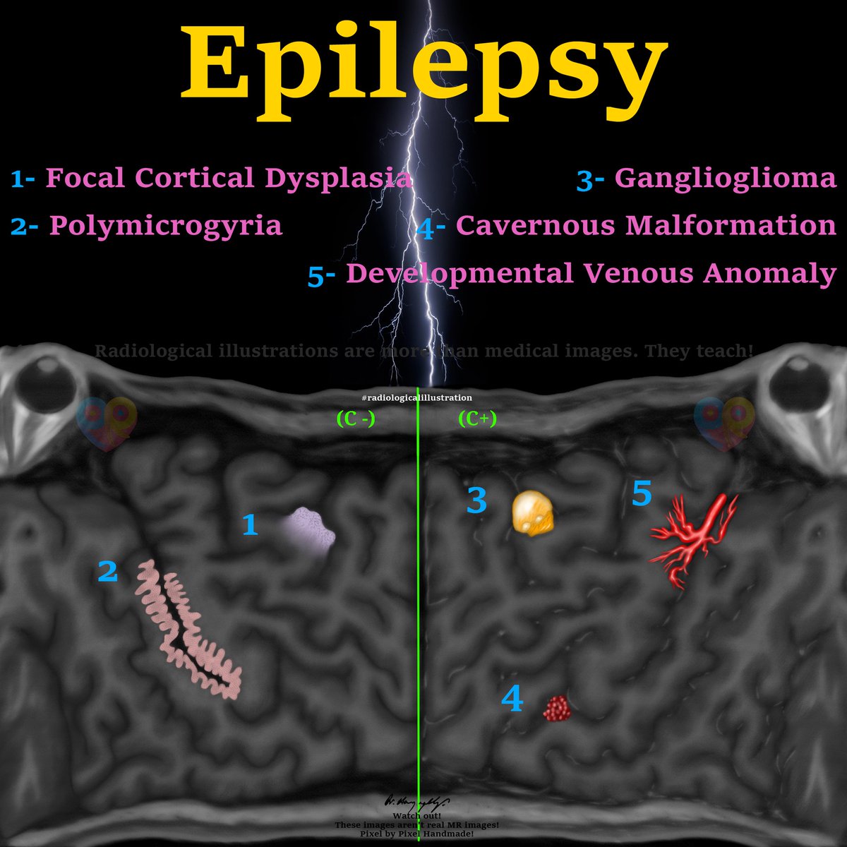 drharunyildiz's tweet photo. Epilepsy &amp; Mercator Map 

#Epilepsy #EpilepsyAwareness 

#radiologicalillustration ✍️ https://t.co/mgIiSdI5gY