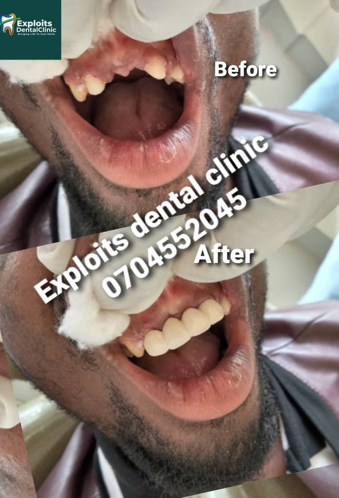 Exploitsdental's tweet image. Teeth replacement with a pfm Bridge. Call or whatsapp 0704552045
#teethalignment #teethwhitening #teethcare