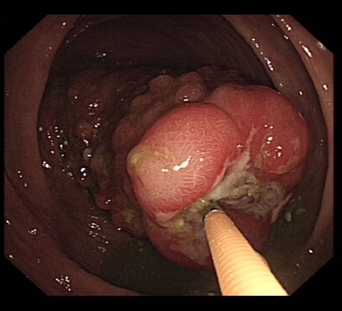FrontGastro_BMJ's tweet image. A &quot;caecal surprise&quot; - great case report on intussusception 👇 

bit.ly/3ne6dN4

@RMBeattie50 #InsideView #Endoscopy @ESGE_news