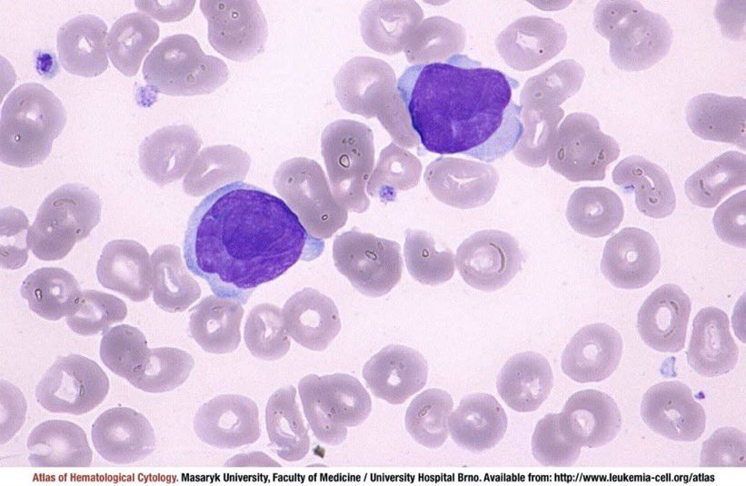 A 48 year old man presented with dyspnea, cough & a worsening itchy red rash all over his body. Labs w/⬆️WBC, ⬇️Hb, platelets. What is the diagnosis? #Hemetwitter tinyurl.com/2p935xr4