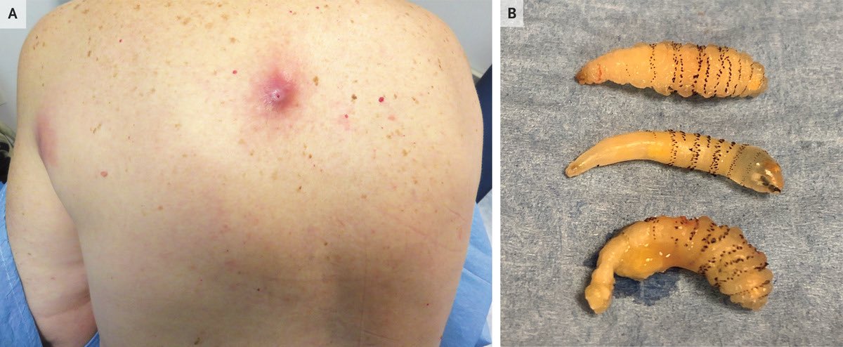 BrownJHM's tweet image. A 62-year-old woman p/w pruritic, draining nodules on the back &amp;amp; buttocks. She reported an associated biting sensation that worsened at nighttime. Two months earlier, she had traveled to Colombia and recalled receiving several mosquito bites. What is the likely diagnosis? #medEd