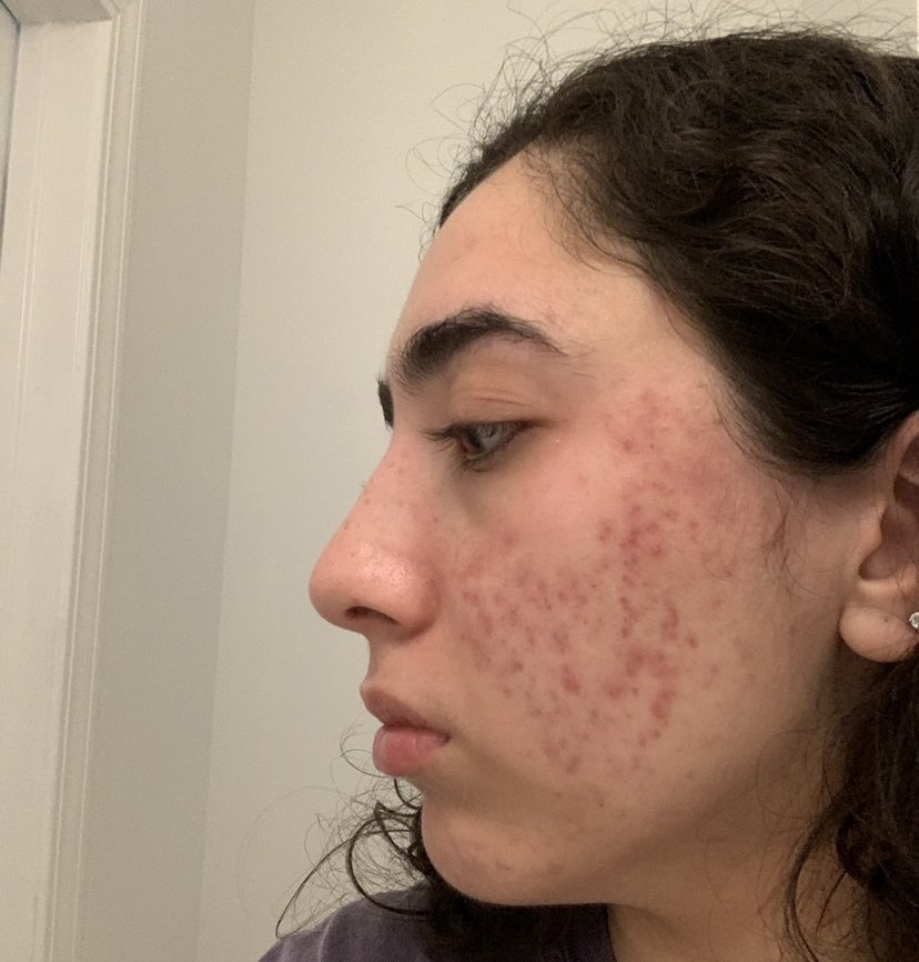 EmaniMone's tweet image. Client transformation: Chemical peels + skincare