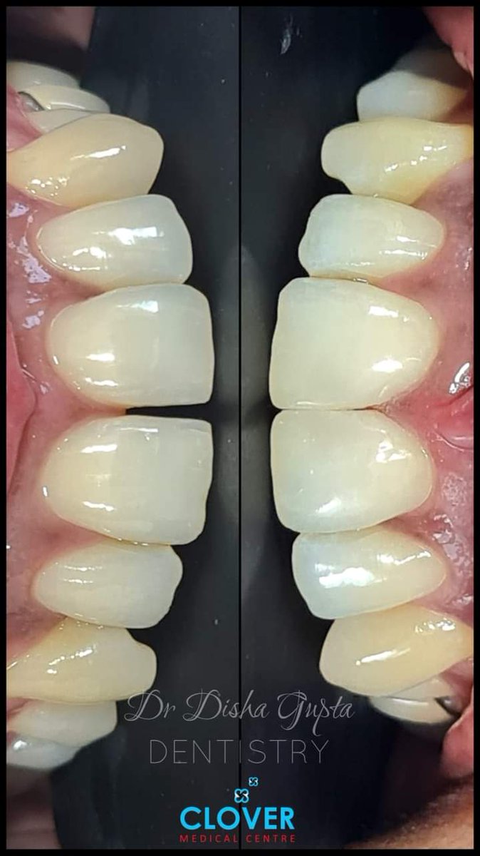 CloverDentist's tweet photo. Gaps between your teeth?
Don't worry. We got the PERFECT smile waiting for you!!
Closure of midline diastema using composite- A case by Dr Disha Gupta
Call 055 120 9888 To Book an Appointment with Dr. Disha Gupta
#teethfiling #smilemakeover #midlinediastemaclosure #smile https://t.co/XMEr4yyigB