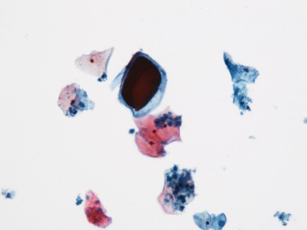 Pap test. Vegetable material.
Can be mistaken for abnormal cells, parasites,even HSV.Is unusual findings.  May be due to vaginal pessaries creams  containing polysaccharide galactomannan, PMID: 16355382 #cytopath #cytofellows #pathresidents