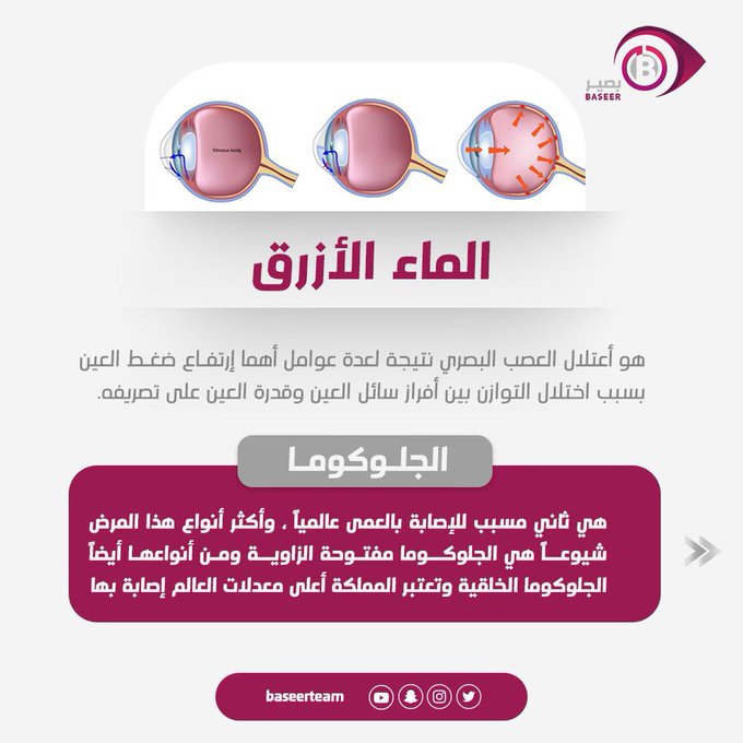 3mmar_18's tweet photo. 🔷🔷🔷🔷🔷

الجلوكوما ، الموية السوداء ،الماء الأزرق ، ارتفاع ضغط العين ،
أسماء عديدة لمرض واحد 

تعرف على  أعراضه وطرق علاجه والوقايه منه 👇🏻👇🏻 https://t.co/ExA6sRnvUR