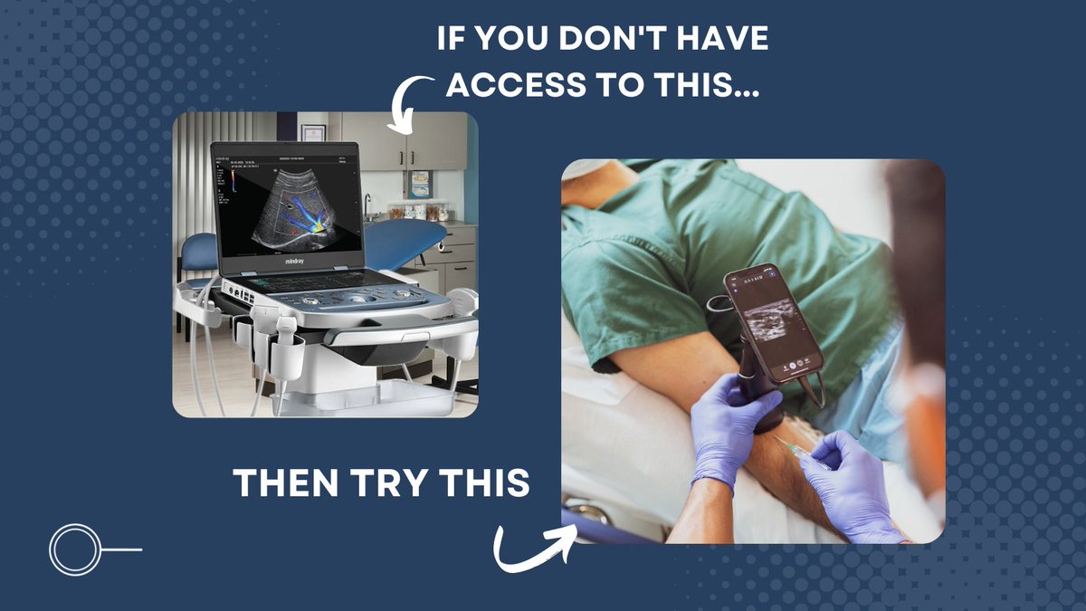 Let’s face it, we don’t all have access to big ultrasound machines. That’s why Butterfly IQ+ and OcuLine go hand in hand to make IV guided ultrasound procedures more accessible to all. 

#ButterflyiQ #POCUS  #ultrasoundguided