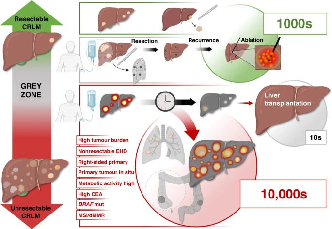 Kjetil Søreide (@ksoreide) on Twitter photo Liver transplantation for non-resectable colorectal liver metastases: many have strong opinions pro-con... here is my brief (philosophical) take on it (thnx to <a href="/BrJCancer/">British Journal of Cancer</a> for the invite)... : rdcu.be/c8rLS <a href="/BrJCancer/">British Journal of Cancer</a> <a href="/hpb_so/">SoMe4HPB</a> <a href="/EAHPBA/">E-AHPBA</a> <a href="/IHPBA/">IHPBA</a> <a href="/EASLnews/">EASLnews</a> <a href="/SoMeTransplant/">SoMe4Transplant</a> Liver transplantation for non-resectable colorectal liver metastases: many have strong opinions pro-con... here is my brief (philosophical) take on it (thnx to <a href="/BrJCancer/">British Journal of Cancer</a> for the invite)... : rdcu.be/c8rLS <a href="/BrJCancer/">British Journal of Cancer</a> <a href="/hpb_so/">SoMe4HPB</a> <a href="/EAHPBA/">E-AHPBA</a> <a href="/IHPBA/">IHPBA</a> <a href="/EASLnews/">EASLnews</a> <a href="/SoMeTransplant/">SoMe4Transplant</a>