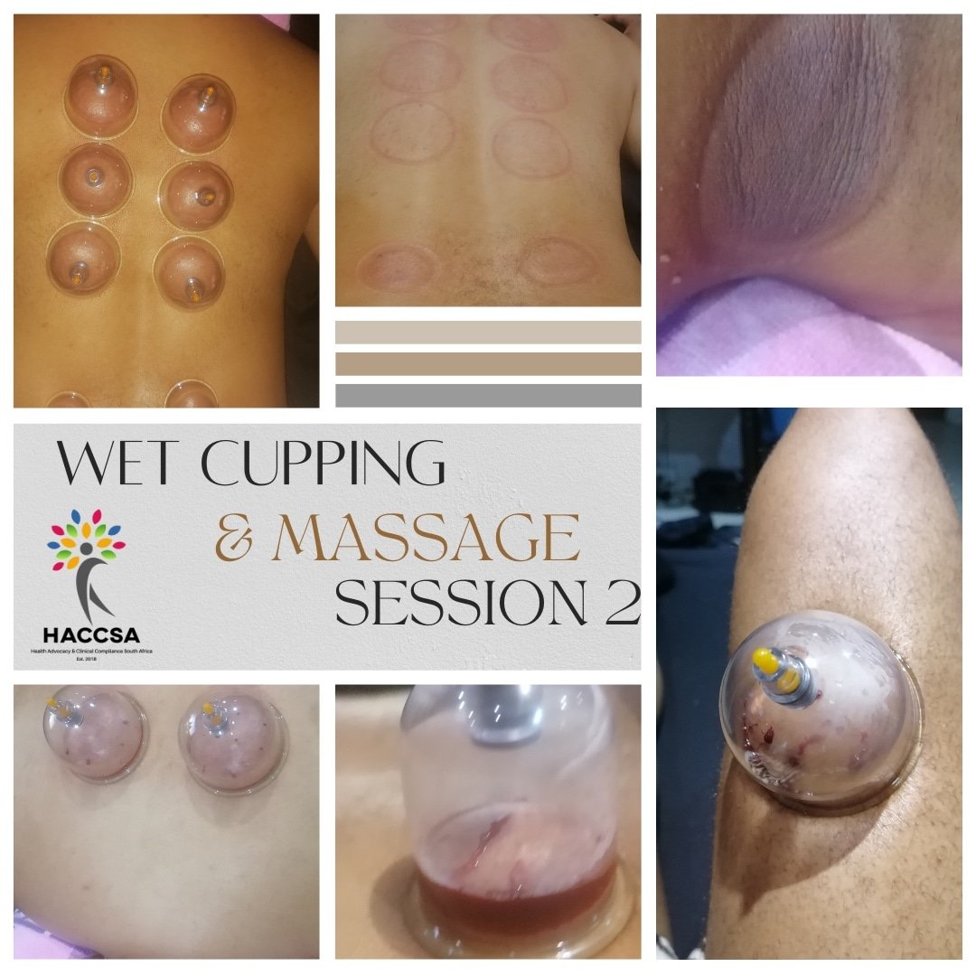 HACCSA - Health Advocacy & Clinical Compliance SA (@haccsas) on Twitter photo Today's session was lit! #WetCuppingTherapy & #DryCuppingTherapy done by <a href="/rene_sparks/">René Sparks #HealthEquityAdvocate</a>
3 clients agreed to wet cupping & 1 dry cupping.
Cupping provides #holistichealthcare
#Selfcare #selflove
<a href="/ChoonaraShakira/">Doc Shakira Choonara</a> <a href="/TekanoSA/">Atlantic Fellows for Health Equity SA</a> <a href="/atlanticfellows/">Atlantic Fellows</a> @AspenNewVoices <a href="/drtlaleng/">Dr Tlaleng Mofokeng</a> <a href="/HastSig/">PHASA Civil Society HAST SIG</a> Today's session was lit! #WetCuppingTherapy & #DryCuppingTherapy done by <a href="/rene_sparks/">René Sparks #HealthEquityAdvocate</a>
3 clients agreed to wet cupping & 1 dry cupping.
Cupping provides #holistichealthcare
#Selfcare #selflove
<a href="/ChoonaraShakira/">Doc Shakira Choonara</a> <a href="/TekanoSA/">Atlantic Fellows for Health Equity SA</a> <a href="/atlanticfellows/">Atlantic Fellows</a> @AspenNewVoices <a href="/drtlaleng/">Dr Tlaleng Mofokeng</a> <a href="/HastSig/">PHASA Civil Society HAST SIG</a>