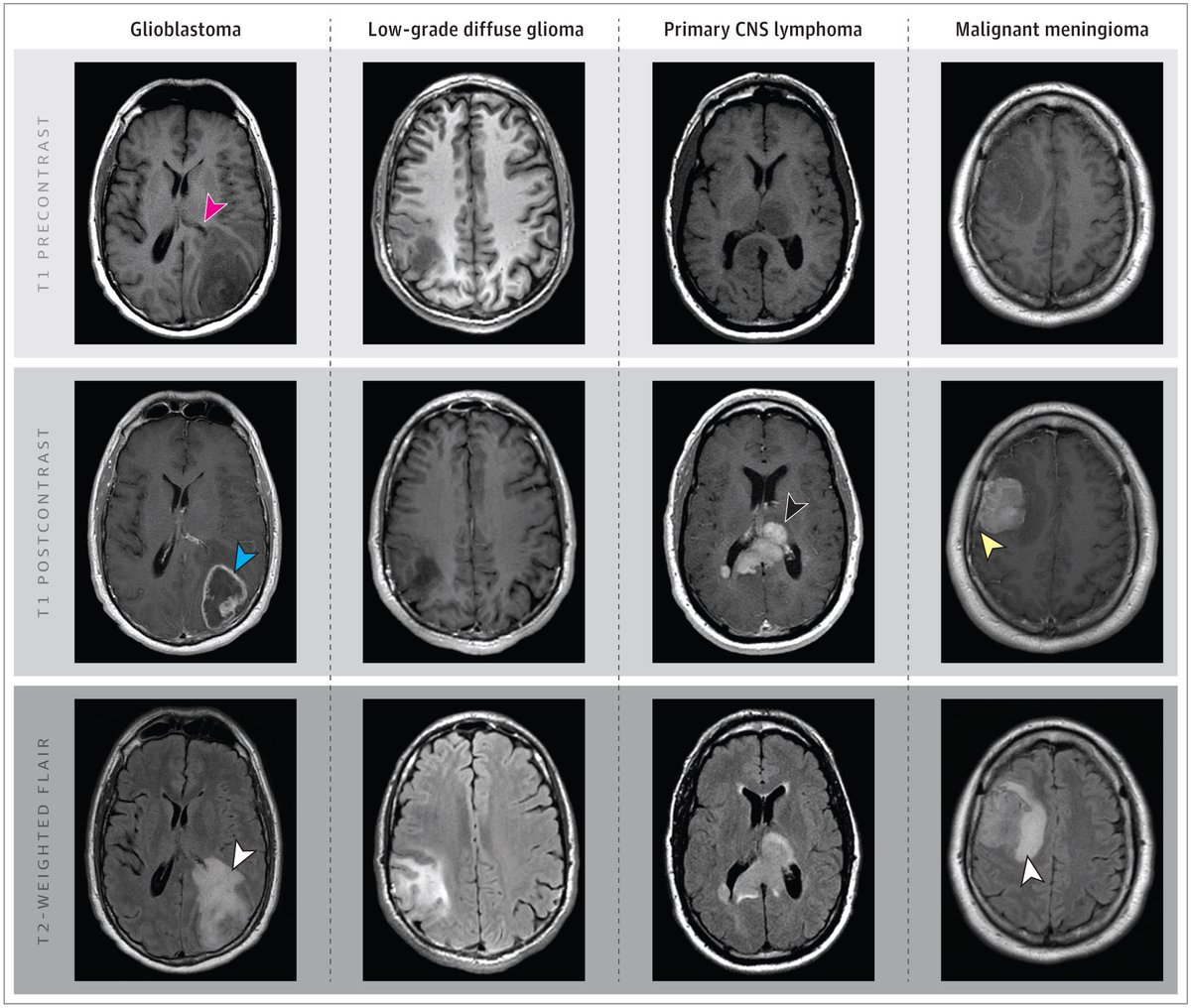 Kirsten Bibbins-Domingo (@kbibbinsdomingo) on Twitter photo Here’s the recent clinical review on glioblastoma and other primary brain malignancies by Drs <a href="/LaurenSchaffMD/">Lauren Schaff, MD</a> & Ingo Mellinghoff <a href="/MSKCancerCenter/">Memorial Sloan Kettering Cancer Center</a>
jamanetwork.com/journals/jama/… Here’s the recent clinical review on glioblastoma and other primary brain malignancies by Drs <a href="/LaurenSchaffMD/">Lauren Schaff, MD</a> & Ingo Mellinghoff <a href="/MSKCancerCenter/">Memorial Sloan Kettering Cancer Center</a>
jamanetwork.com/journals/jama/…