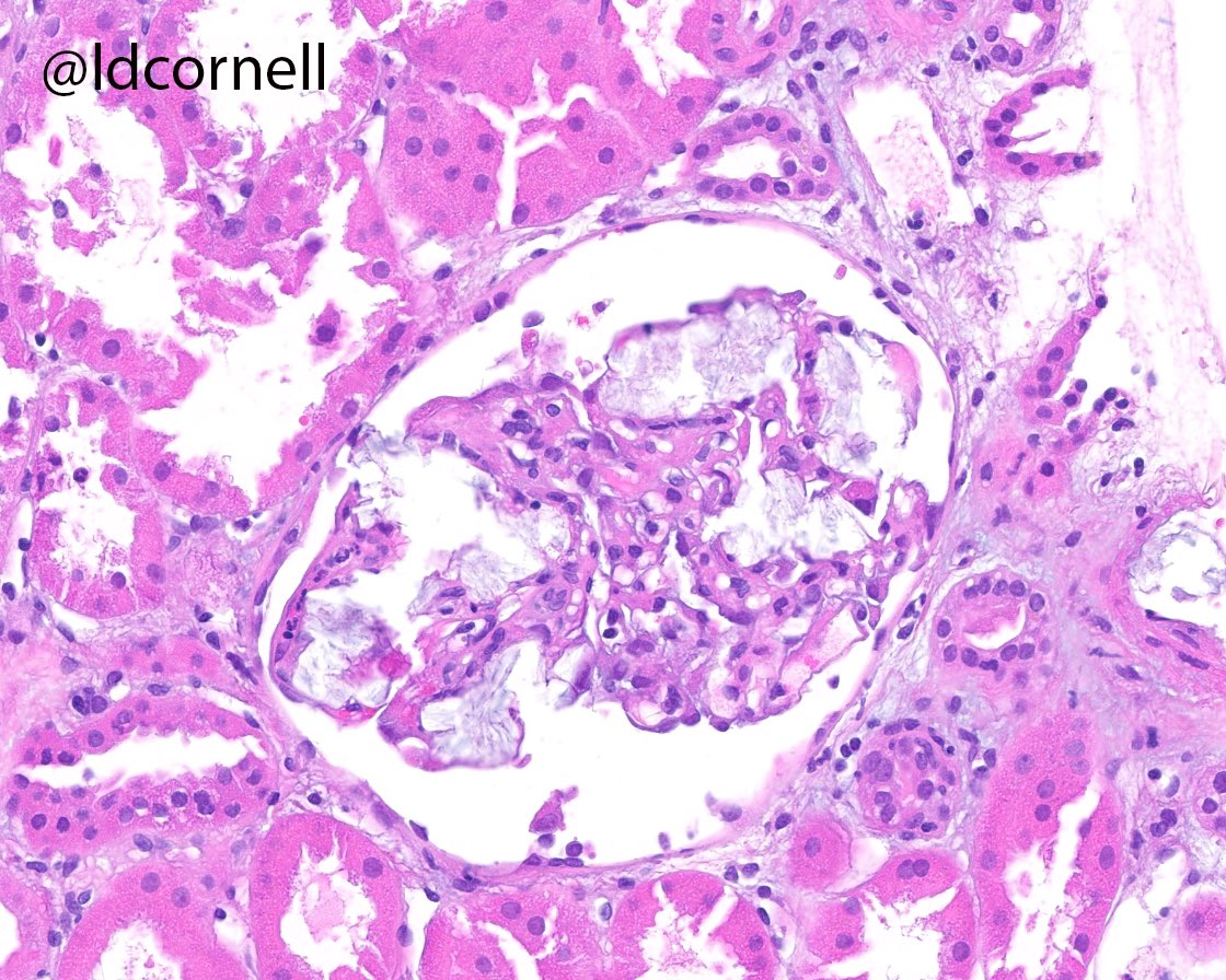 ldcornell's tweet photo. Kidney transplant biopsy from an adult man, 10 months post-transplant. ESRD was due to IgAN. This biopsy was for increased creatinine and proteinuria. Quiz: what are these crystals? (I am intentionally withholding some clinical info!) #renalpath @Renalpathsoc https://t.co/hm84abf3RM