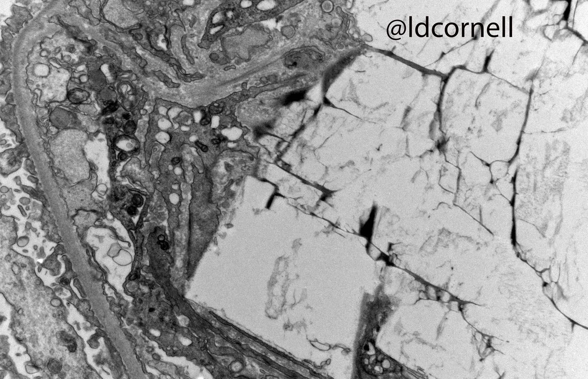 Kidney transplant biopsy from an adult man, 10 months post-transplant. ESRD was due to IgAN. This biopsy was for increased creatinine and proteinuria. Quiz: what are these crystals? (I am intentionally withholding some clinical info!) #renalpath <a href="/Renalpathsoc/">Renal Pathology Society</a>
