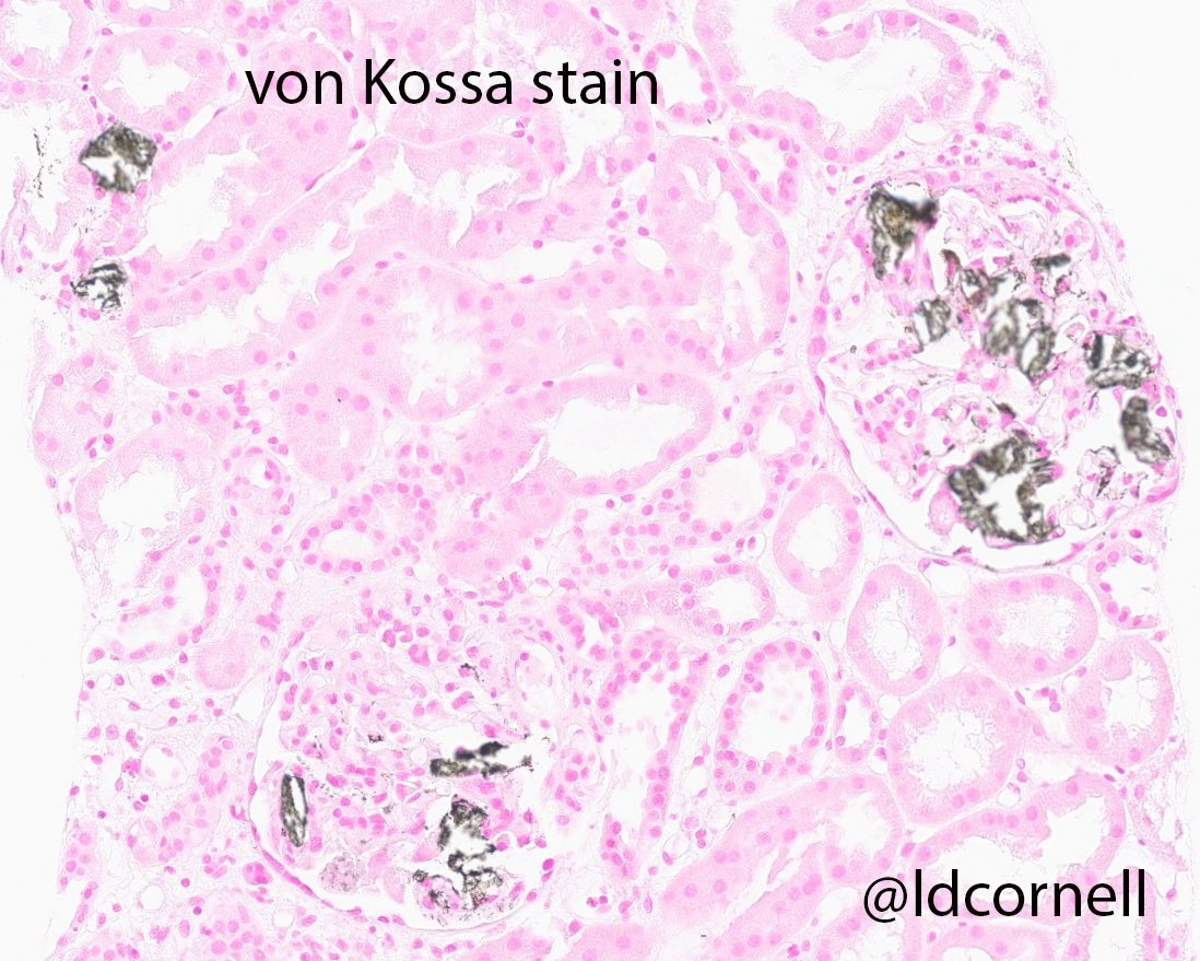 ldcornell's tweet photo. Kidney transplant biopsy from an adult man, 10 months post-transplant. ESRD was due to IgAN. This biopsy was for increased creatinine and proteinuria. Quiz: what are these crystals? (I am intentionally withholding some clinical info!) #renalpath @Renalpathsoc https://t.co/hm84abf3RM
