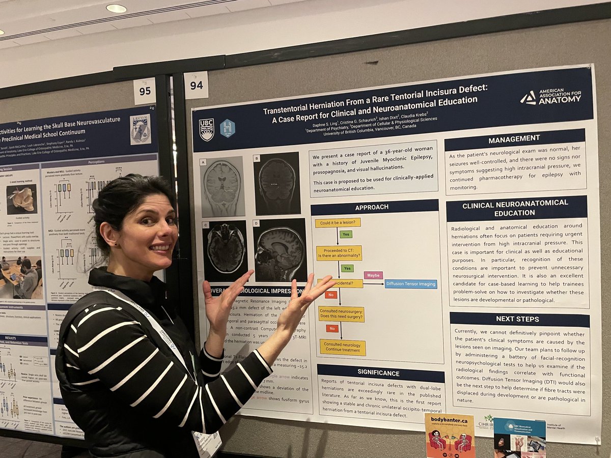 Cristina presenting for ⁦<a href="/daph_ling/">Daphne S. Ling 🧠 👩‍🔬 🇨🇦</a>⁩ about how to approach a case report on an incidental finding if transtentorial herniation in #meded and #anatomy education ⁦<a href="/HiveUBCMedicine/">HIVE UBC</a>⁩ ⁦<a href="/AnatomyOrg/">American Association for Anatomy</a>⁩