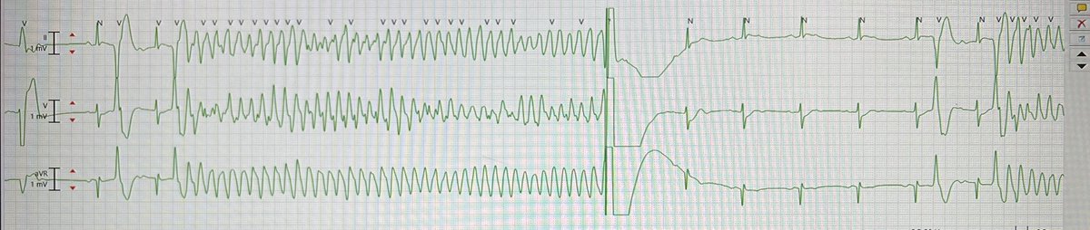 Roderick Tung (@drrodericktung) on Twitter photo Two classic ECG tracings on University Cardiology Service rounds <a href="/uazmedphx/">UAZ Medicine - Phoenix</a>
1. Ashman phenomenon during AF/AFL with progressive and persistent RBBB concealment
2. PMVT storm two weeks s/p acute MI with stereotypic PVC (LPF) trigger. Rx: overdrive pacing, quinidine, ablation Two classic ECG tracings on University Cardiology Service rounds <a href="/uazmedphx/">UAZ Medicine - Phoenix</a>
1. Ashman phenomenon during AF/AFL with progressive and persistent RBBB concealment
2. PMVT storm two weeks s/p acute MI with stereotypic PVC (LPF) trigger. Rx: overdrive pacing, quinidine, ablation
