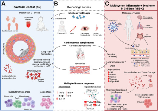 yoncabulutmd's tweet image. "IVIG is efficient in treating both #MISC and KD patients; however, affected patients need to be followed over time to monitor the emergence or persistence of cardiovascular 

 #MISC #KawasakiDisease #Covid19 #PedsICU 
@ArditiMd @LaelYonker @BrodinPetter @lizWWyld @InfectiousDz