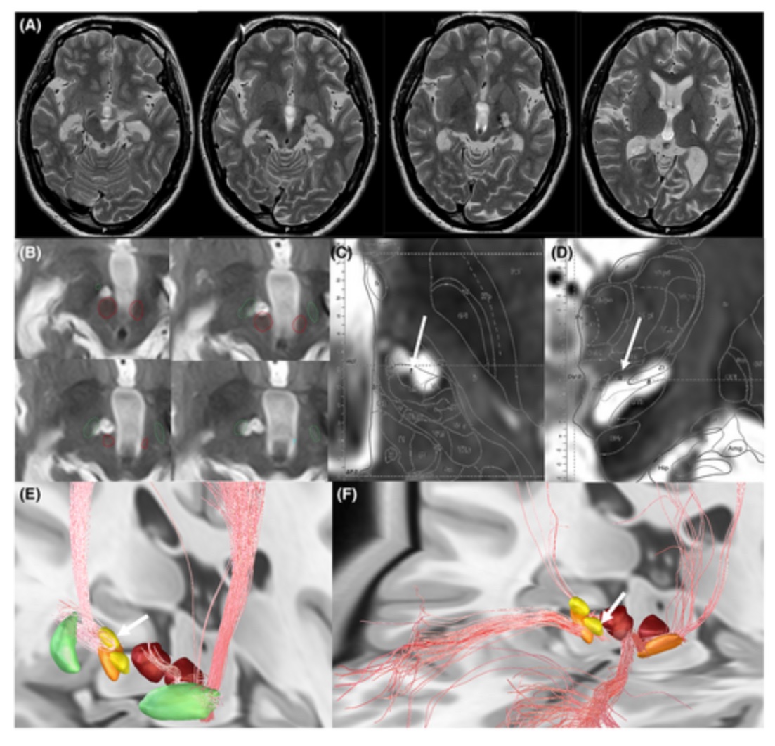 Interesting case validating two of our studies: Stereotactic lesions in a lady with tardive dystonia improved both dystonia and OCD. Lesion hit both OCD- (@NingfeiL et al 2020 @NatureComms) and Dystonia- (Horn et al. 2022 @PNASNews) response networks. onlinelibrary.wiley.com/doi/10.1002/ac…