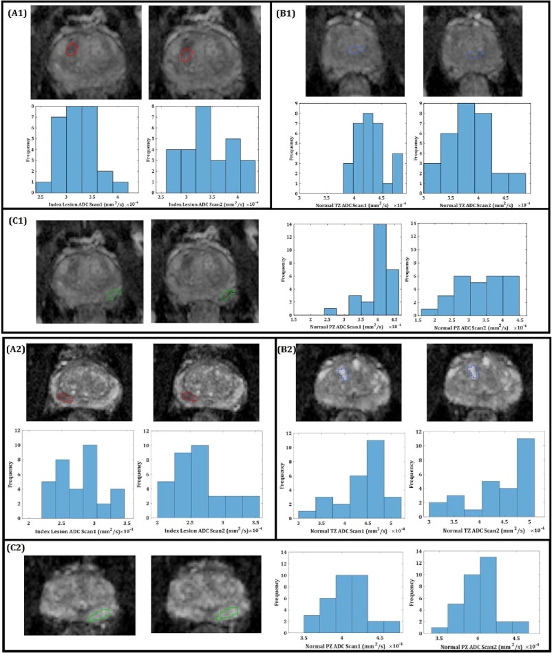 Excited for the publication of Test-retest Repeatability of ADC in Prostate using the Multi b-Value VERDICT Acquisition doi.org/10.1016/j.ejra… from @shonitP and the <a href="/CMI_UCL/">Centre for Medical Imaging</a> group with my colleagues from <a href="/RSNA/">RSNA</a> Quantitative Imaging Biomarker Alliance on #ProstateMRI