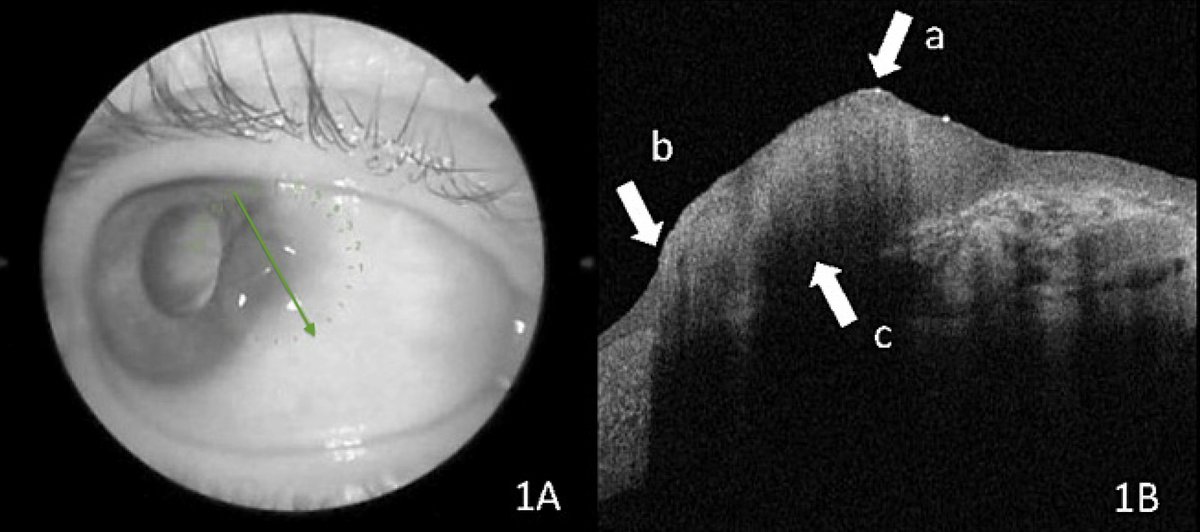 revoptom's tweet image. OCT Can Help Diagnose Ocular Surface Squamous Neoplasia
The technology has been shown to effectively differentiate between malignancy and benign pterygia.

reviewofoptometry.com/article/oct-ca…

#ocularcancer #ocularsurface #anteriorsegment #cornea #optometry #eyecare #corneaspecialist