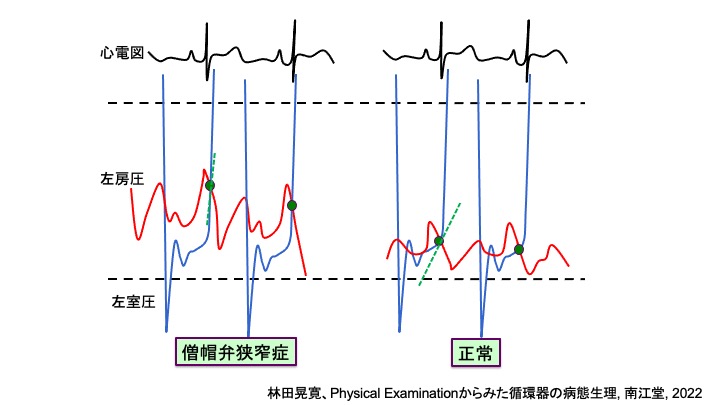 hay_akihiro's tweet photo. #PhysicalExam 僧帽弁狭窄症(MS)での1音亢進のメカニズム。左房圧が上昇し、左室収縮圧の傾きが大きいところで1音が閉鎖するため。弁の可動性が低い高齢者の動脈硬化性MSでは1音亢進は目立たない。 https://t.co/qfMVlDT3OA