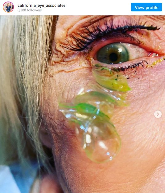 ภาพที่เห็นอยู่นี้คือเคสที่หมอยังต้องอึ้ง ผู้หญิงคนนี้มาหาหมอเพราะรู้สึกเจ็บตา แต่กลายเป็นว่าหมอดันเจอคอนแทคเลนส์ซ้อนกันซ่อนอยู่ในตาถึง 23 เลนส์! ซึ่งเธอก็ใส่คอนแทคเลนส์มาตลอดร่วมสามสิบปี และทั้งที่เธอลืมคอนแทคเลนส์ไว้ในตามากขนาดนั้น