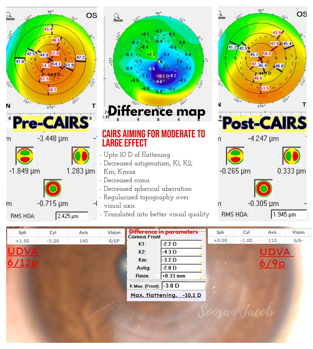 drsoosanjacob's tweet photo. CAIRS aimed at moderate to large effect
#CAIRS #cornealallogenicintrastromalringsegments #keratoconus #keratoconusawareness #conicalcornea #DALK #CornealCrosslinking #cornealtransplant #postlasikectasia #ophthalmologyresident #ophthalmology #ICRS #INTACS #customizedcairs https://t.co/wFb1FANgKJ