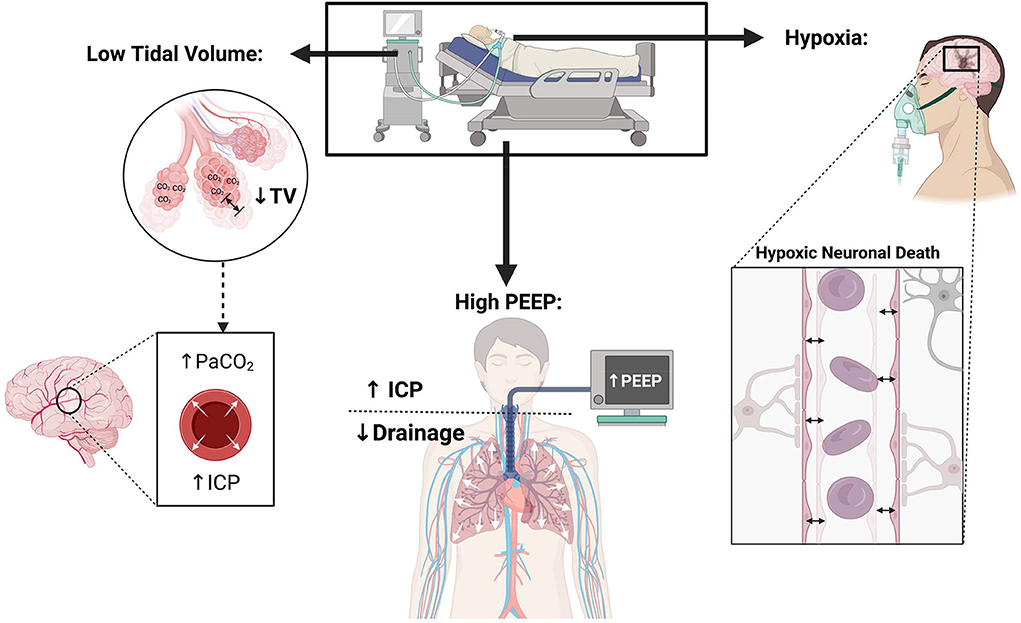 CritCareReviews's tweet photo. Today's Paper of the Day is by Mariyam Humayun on mechanical ventilation in acute brain injury patients with ARDS
https://t.co/JKgcYjlUQ5
#criticalcare #intensivecare #ICU #FOAMed #FOAMEDcc #MedTwitter https://t.co/0Kcqv25OGO