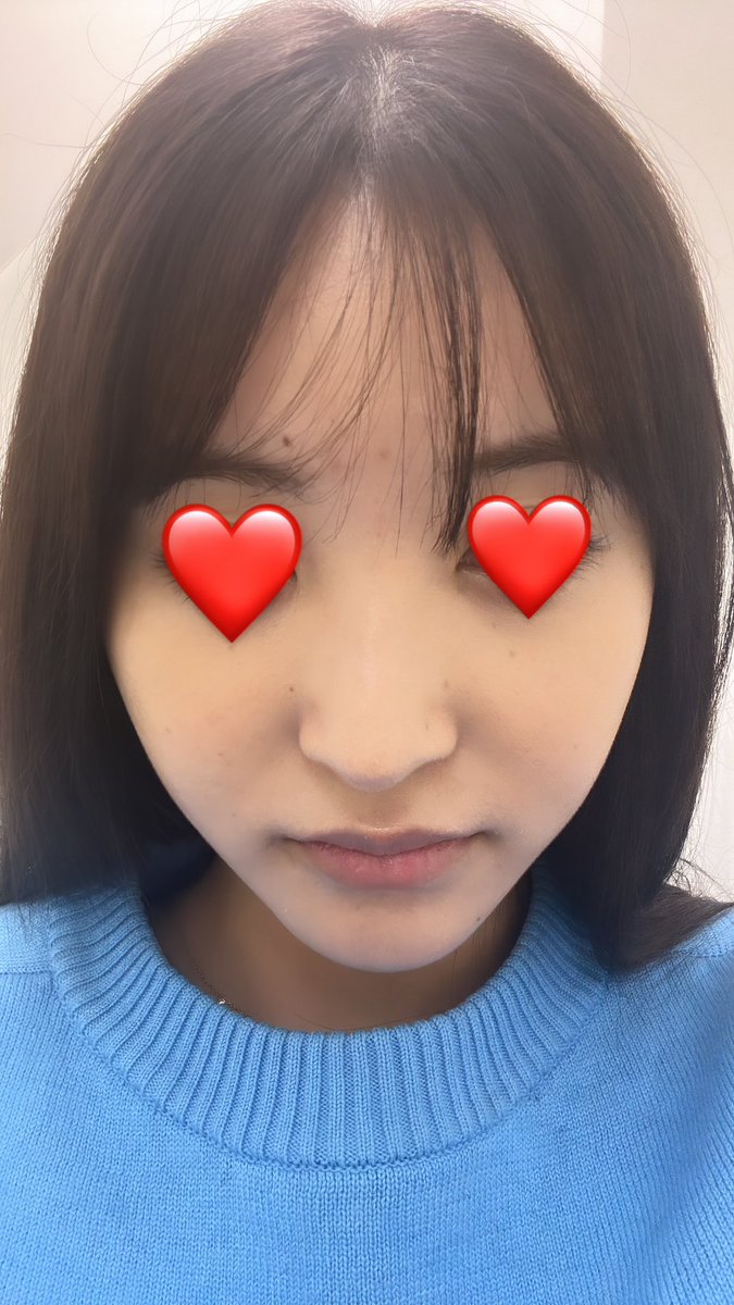 2Pfyy's tweet photo. 思いついたらすぐ行動派だから早速ほうれい線撃退してきた👶🏻

どっちもノマカメ撮影です🐢

貴族フィラー(ボリフト1cc) 2.9万円

柔らかめのヒアルだから鼻横の凹みに対してはどうかなって話してたけどかなり効果あり🥺
内出血もないしかなり満足度高い！❤️❤️

←ビフォー　　アフター→ https://t.co/oqXueNyZQb