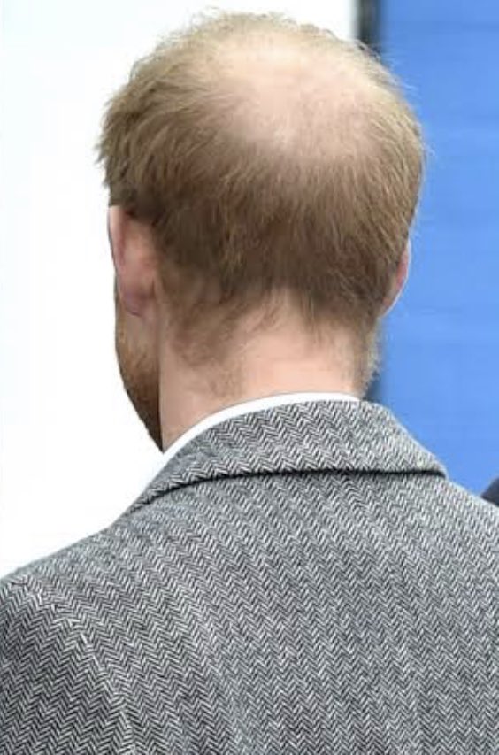 PPeabody21's tweet image. Just because I can’t stand the man he has become &amp;amp; also smirking about his brothers hair loss I am going to use the hashtag #HairHairplugs #WorldWidePrivacyTour #WeWANTOurPrivacy #SouthPark #InstagramLovingBWife #HarryandMeghanAreAJoke #HarryAndMeghanAreFinished #Hypocrites